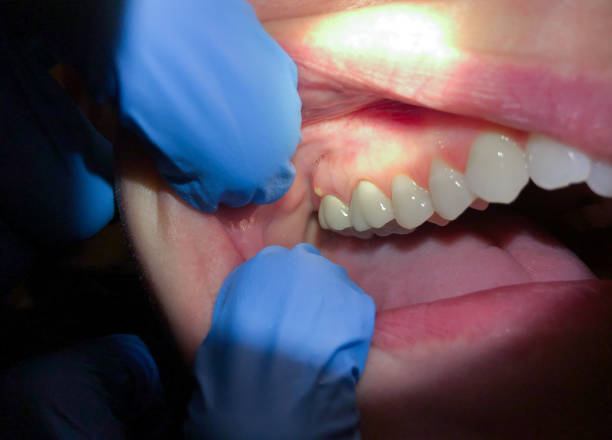 Best Emergency Dental Care for Abscessed Tooth in Fairview, OK